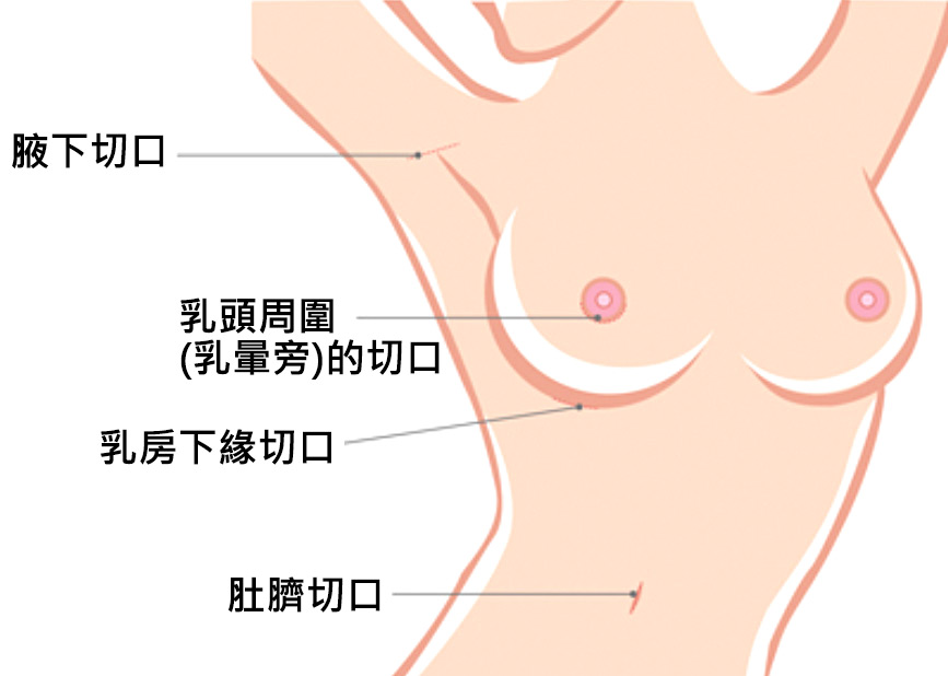 隆乳手術 聖路加美容醫學中心 輔大醫院